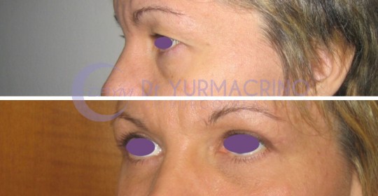 Blepharoplasty – Case 10/B