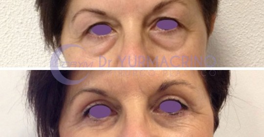 Blepharoplasty – Case 11/A