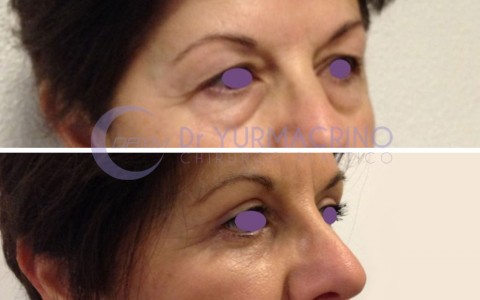 Blepharoplasty – Case 11/B