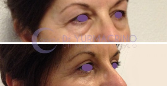 Blepharoplasty – Case 11/B