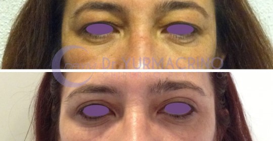 Blepharoplasty – Case 12/A