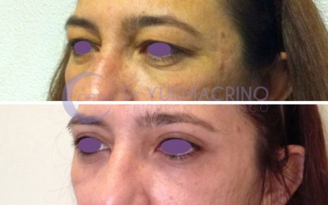 Blepharoplasty – Case 12/B