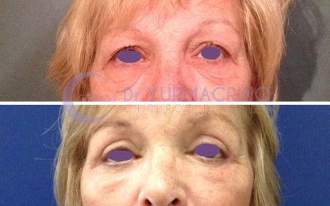 Blepharoplasty – Case 13/A