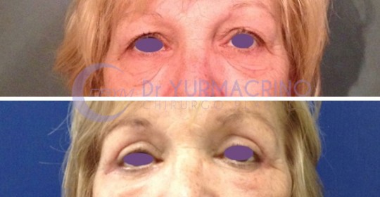 Blepharoplasty – Case 13/A