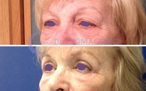 Blepharoplasty – Case 13/B