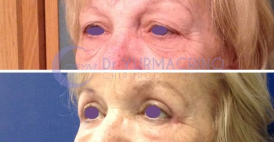 Blepharoplasty – Case 13/B