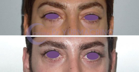 Blepharoplasty – Case 14/A