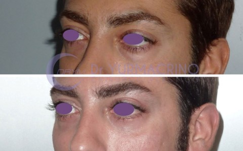 Blepharoplasty – Case 14/B