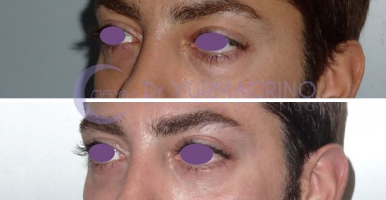 Blepharoplasty – Case 14/B