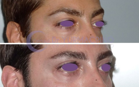 Blepharoplasty – Case 14/C