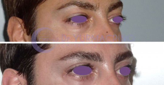 Blepharoplasty – Case 14/C