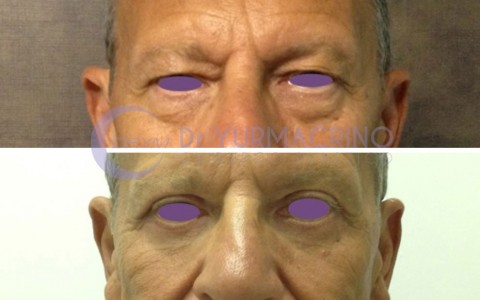 Blepharoplasty – Case 15/A