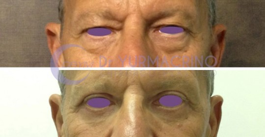 Blepharoplasty – Case 15/A