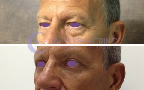 Blepharoplasty – Case 15/B