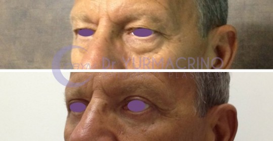 Blepharoplasty – Case 15/B