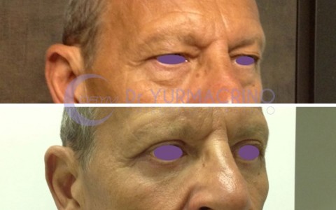 Blepharoplasty – Case 15/C