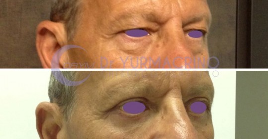 Blepharoplasty – Case 15/C