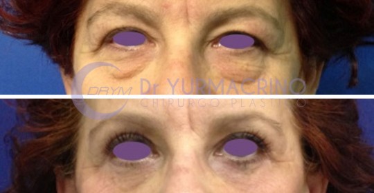 Blepharoplasty – Case 16/A