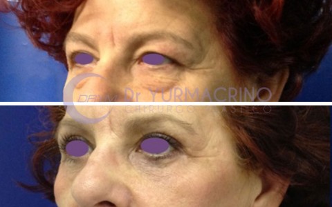 Blepharoplasty – Case 16/B