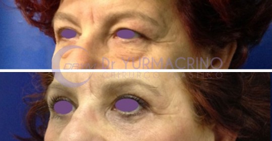 Blepharoplasty – Case 16/B