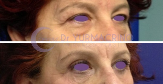 Blepharoplasty – Case 16/C