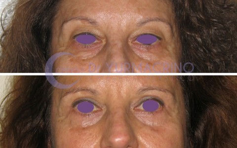 Blepharoplasty – Case 17