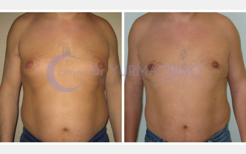 Gynecomastia – Case 1/A