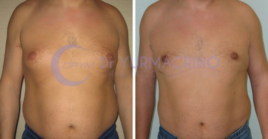 Gynecomastia – Case 1/A