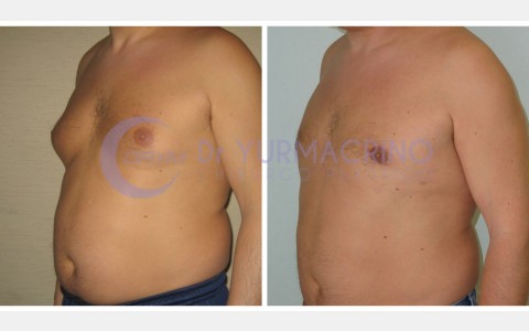 Gynecomastia – Case 1/B