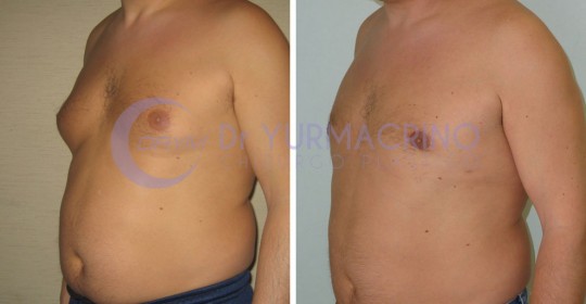 Gynecomastia – Case 1/B