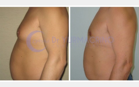 Gynecomastia – Case 1/C