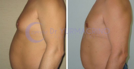 Gynecomastia – Case 1/C