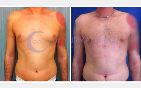 Gynecomastia – Case 2/A