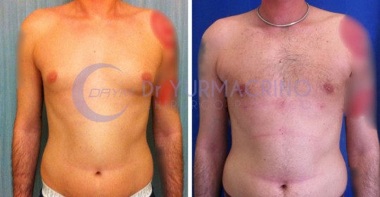 Gynecomastia – Case 2/A