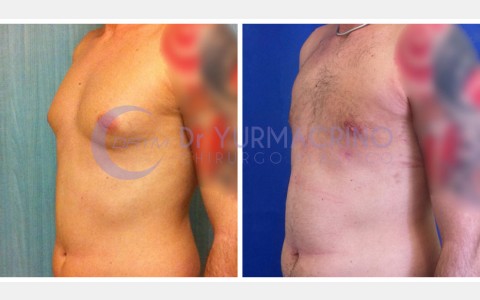 Gynecomastia – Case 2/B