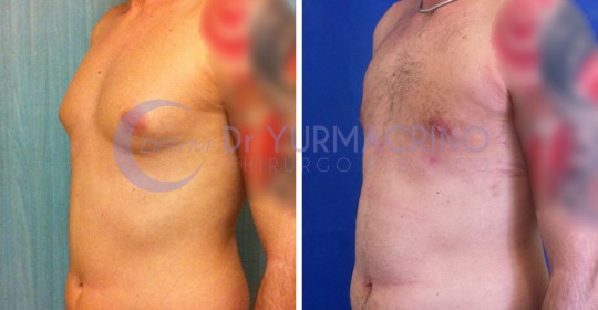 Gynecomastia – Case 2/B