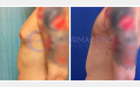 Gynecomastia – Case 2/C