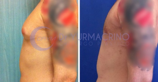 Gynecomastia – Case 2/C