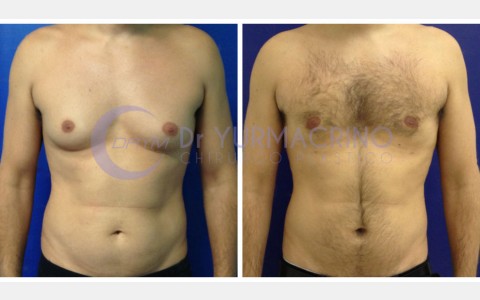 Gynecomastia – Case 3/A