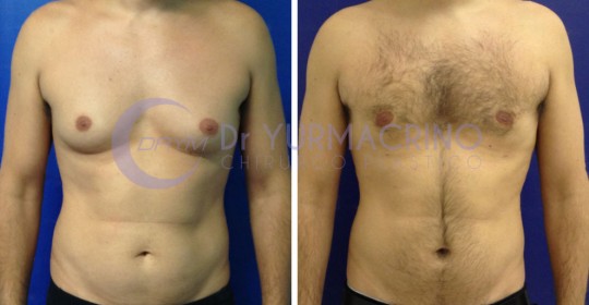 Gynecomastia – Case 3/A