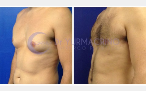 Gynecomastia – Case 3/B