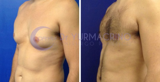 Gynecomastia – Case 3/B