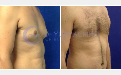 Gynecomastia – Case 3/C