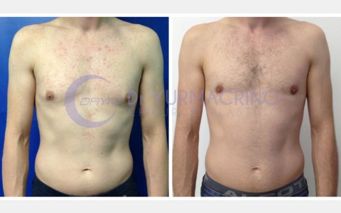 Gynecomastia – Case 4/A