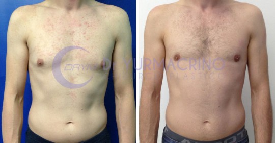 Gynecomastia – Case 4/A