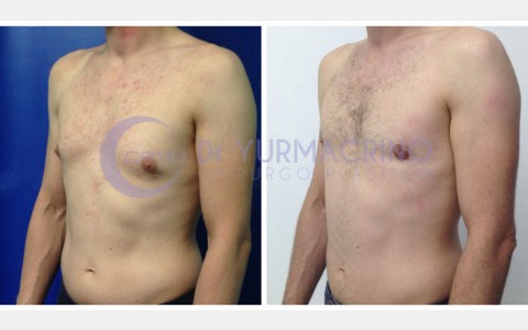 Gynecomastia – Case 4/B