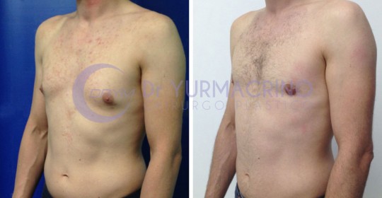 Gynecomastia – Case 4/B