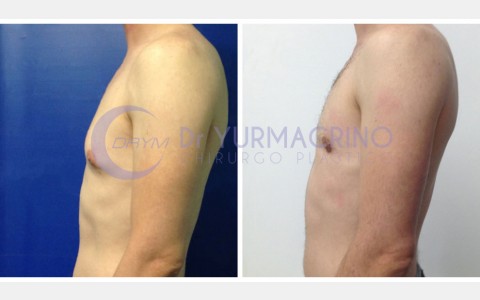 Gynecomastia – Case 4/C