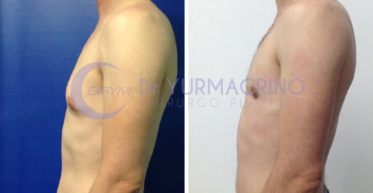 Gynecomastia – Case 4/C