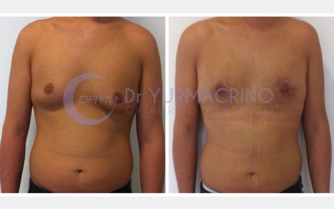 Gynecomastia – Case 5/A